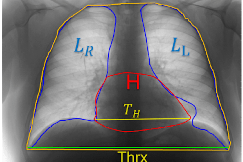 Automatic estimation of heart boundaries and cardiothoracic ratio
